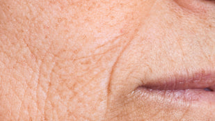 Wrinkles & Fine Lines