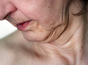 Loss of Firmness & Elasticity
