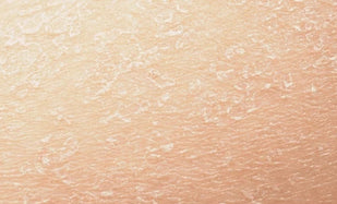 Dry Rough Skin